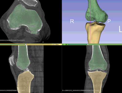 Total Knee Replacement: Subject-Specific Modeling, Finite Element Analysis and Evaluation of Dynamic Activities
