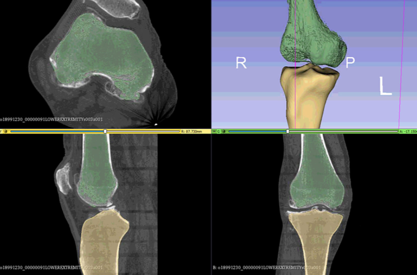 Total Knee Replacement: Subject-Specific Modeling, Finite Element Analysis and Evaluation of Dynamic Activities